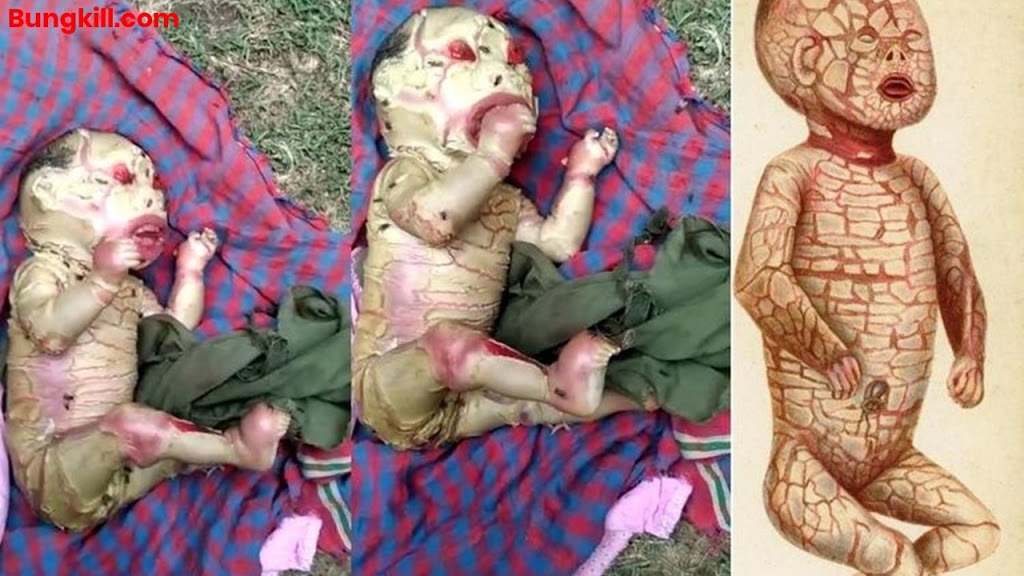 Viral bayi di india 11 bulan: Hoax!!! Bayi dengan Kelainan Genetik